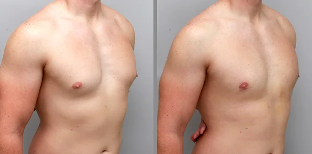 Quarter-side view of male chest before and after gynecomastia surgery, highlighting a flatter, more defined chest contour.
