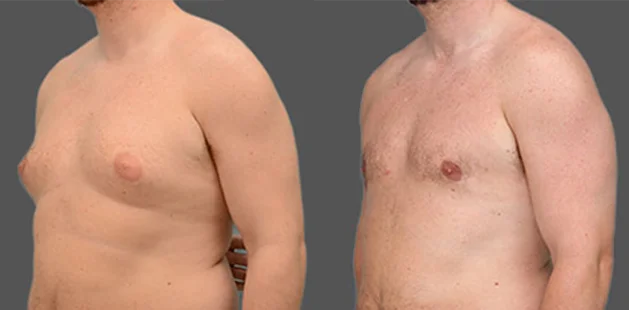 Quarter-side view of gynecomastia surgery results showing improved chest definition.