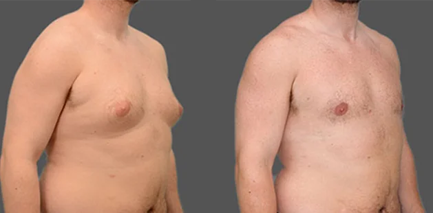 Quarter-side view showing male chest before and after gynecomastia surgery, revealing a smoother, more sculpted chest appearance.