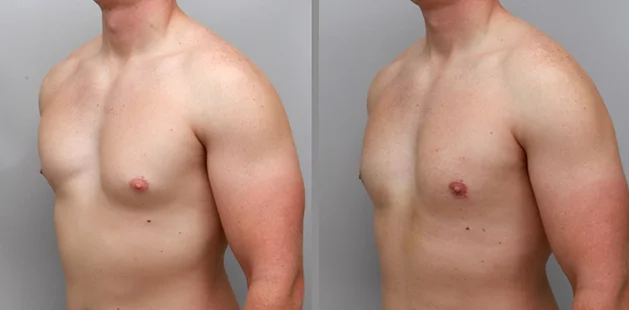 Quarter-side view of gynecomastia surgery results showing improved chest contour and natural definition.