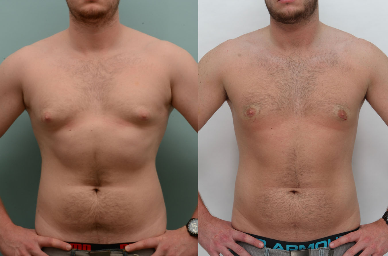 Male body sculpting results at Ditesheim Cosmetic Surgery Charlotte