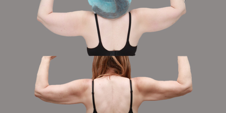 Arms raised at 90 degrees showing symmetrical upper-arm fat distribution from lipedema – Ditesheim Cosmetic Surgery Charlotte