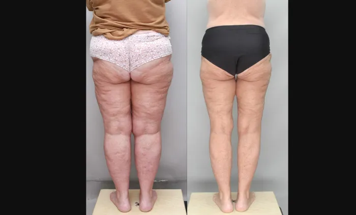 Before and after rear view results of lipedema surgery by Ditesheim Cosmetic Surgery in Charlotte, NC