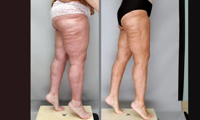 Before and after side view of lipedema surgery on thighs by Ditesheim Cosmetic Surgery.
