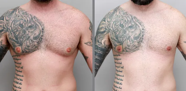 Male gynecomastia treatment result age 33 at Ditesheim Cosmetic Surgery Charlotte North Carolina showing balanced chest contour
