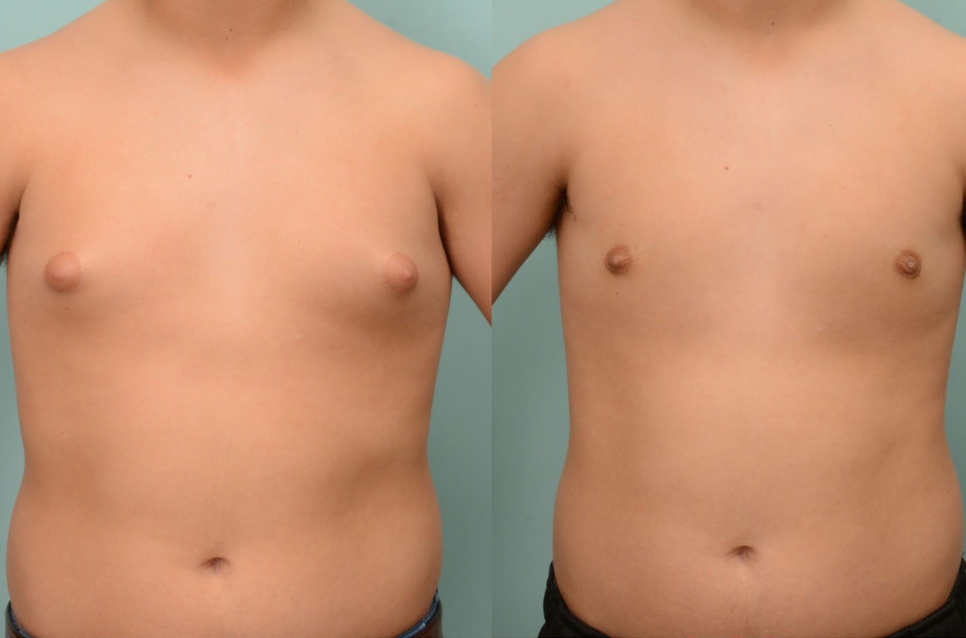 Before and after gynecomastia surgery demonstrating chest flattening and smooth contour refinement