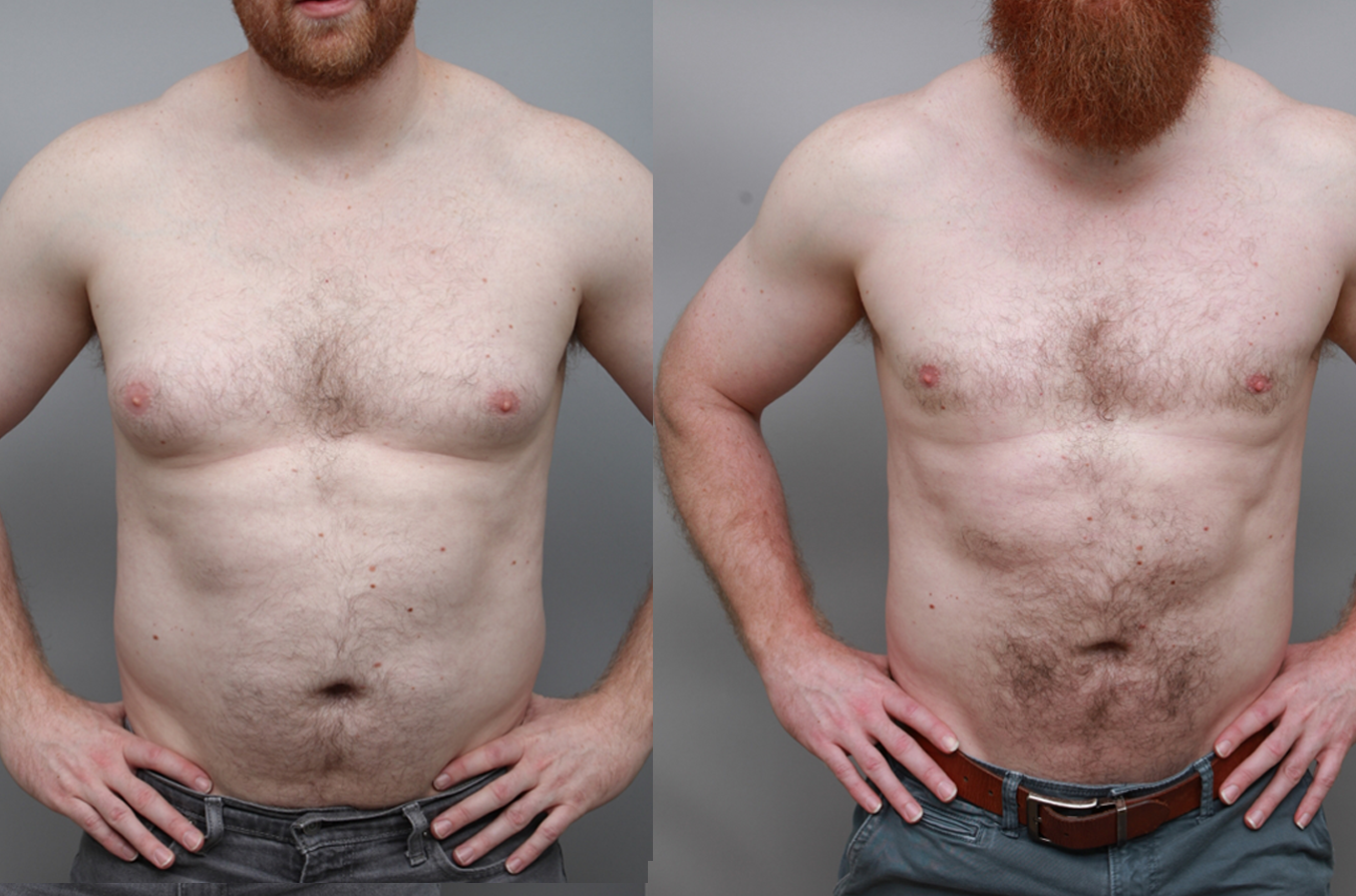 Before and after male chest sculpting demonstrating more defined pectoral area and natural proportions