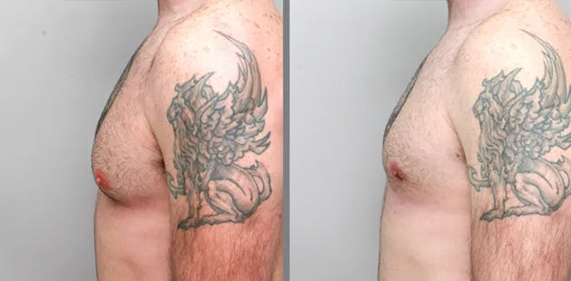 Before and after male chest sculpting demonstrating more defined pectoral area and natural proportions