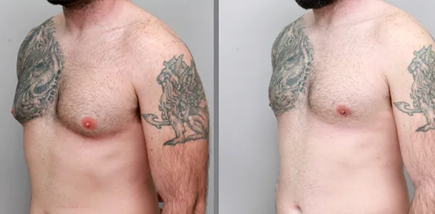 efore and after male chest reduction showing improved contour after gynecomastia surgery | Ditesheim Cosmetic Surgery Charlotte