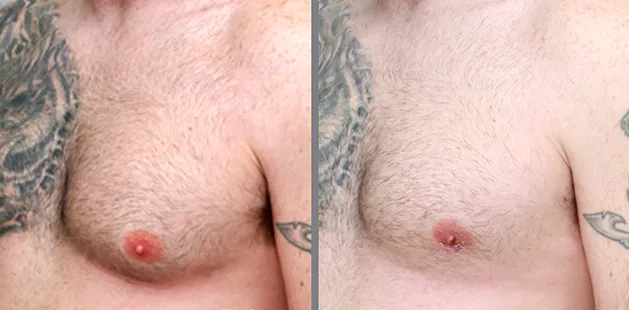 Close-up before and after image of male chest showing reduction of glandular tissue after gynecomastia surgery at Ditesheim Cosmetic Surgery.